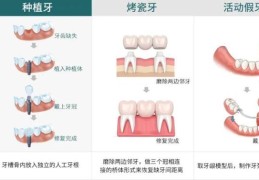 牙齿掉了安装一颗假牙多少钱(牙齿掉了安一颗多少钱)