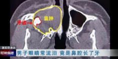 男子流泪不止(竟是鼻子里面长了颗牙齿！医生都惊了)