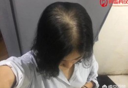 你们的脱发(女生)都是怎么变好的(女人脱发怎么调理)