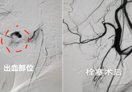 避免口腔溃疡，警惕可能的白塞病症状