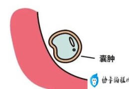 女子以为发胖肚中取出16斤囊肿(囊肿是怎么形成的原因)