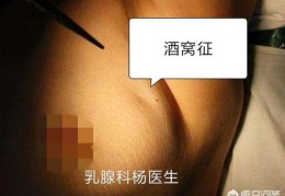 乳腺癌的早期症状有哪些？(乳腺肿瘤有什么症状)