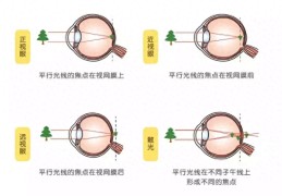 屈光不正和近视眼的区别是什么(近视和屈光不正不是一回事)