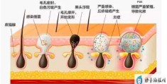 长了青春痘怎么办(长了青春痘应该怎么处理)