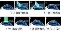 眼睛激光手术多少岁适合做？(做近视眼手术最佳年龄)